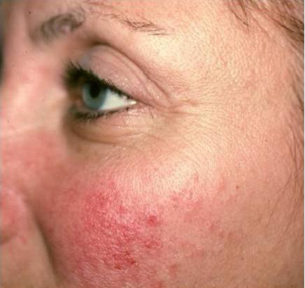 Омоложение кожи лица и устранение купероза методом фототерапии IPL до процедуры