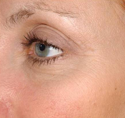 Омоложение кожи лица и устранение купероза методом фототерапии IPL после процедуры