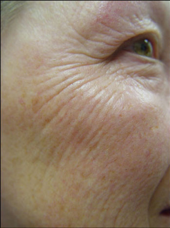Устранение морщин на лице методом фототерапии IPL до процедуры