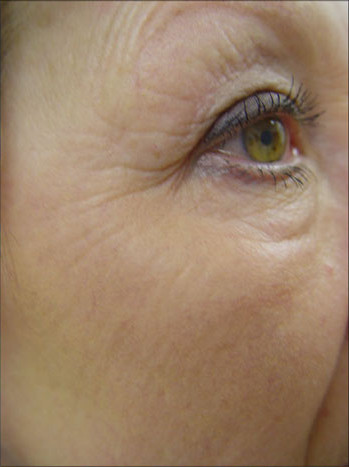 Устранение морщин на лице методом фототерапии IPL после процедуры