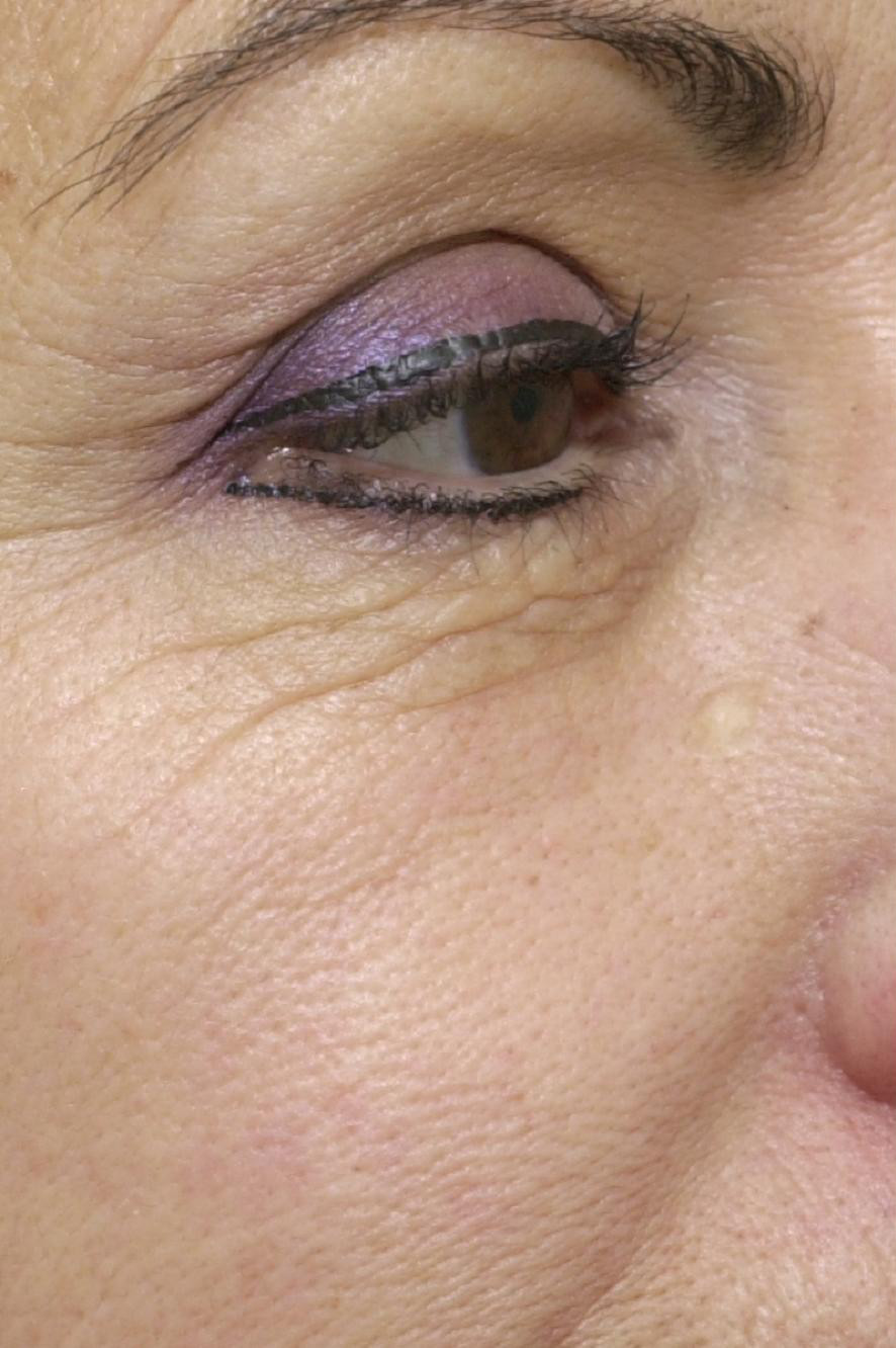 Устранение морщин вокруг глаз методом фототерапии IPL до процедуры