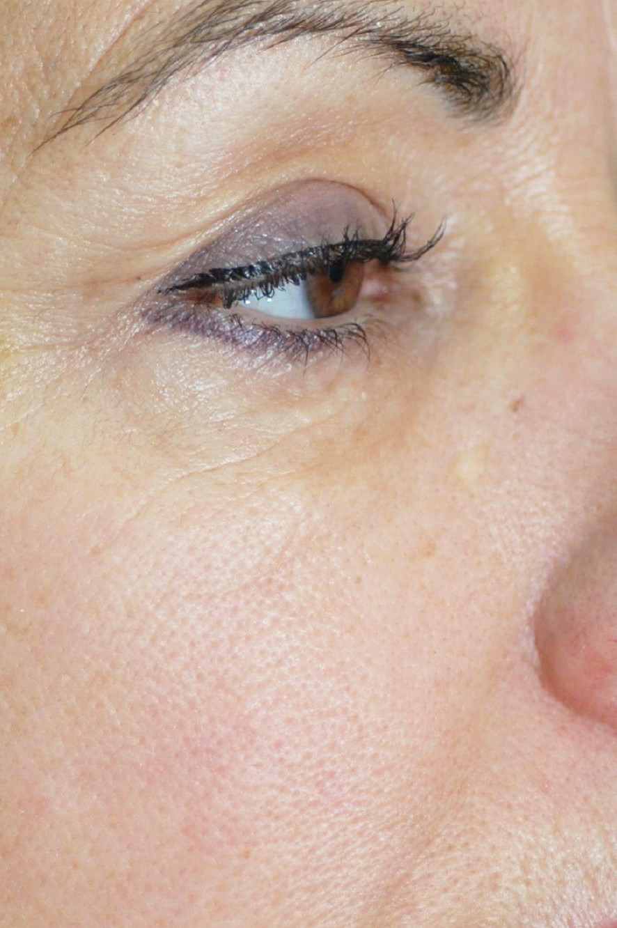 Устранение морщин вокруг глаз методом фототерапии IPL после процедуры