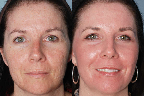 Омоложение кожи лица методом фототерапии IPL