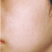Устранение пигментных пятен на лице методом фототерапии IP после процедуры