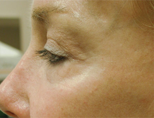 До и после устранения морщин в области глаз лазером Fraxel после процедуры
