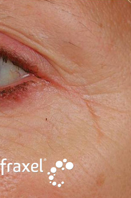 До и после устранения морщин в области глаз лазером Fraxel до процедуры