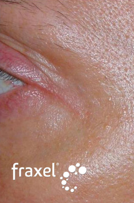 До и после устранения морщин в области глаз лазером Fraxel после процедуры