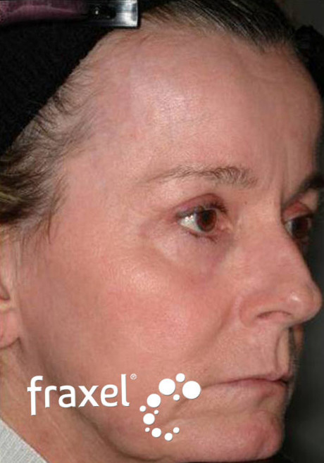 До и после омоложения лица лазером Fraxel после процедуры