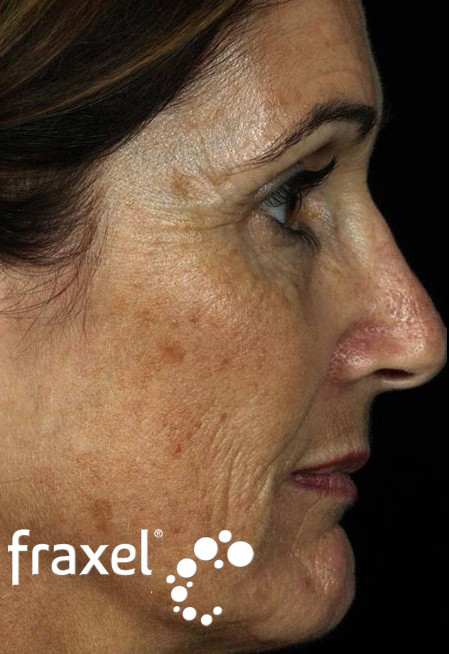 До и после омоложения лица лазером Fraxel до процедуры
