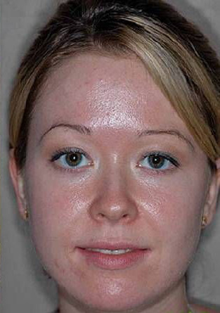 Устранение угревой сыпи на лице с помощь пилинга после процедуры