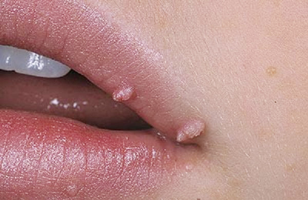 Удаление лазером папилломы на губе до процедуры