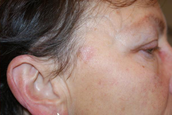 Устранение пигментных пятен на лице лазером после процедуры