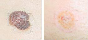 Три стадии процесса заживления после удаления лазером дефекта кожи до процедуры