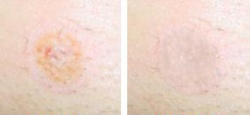 Три стадии процесса заживления после удаления лазером дефекта кожи после процедуры