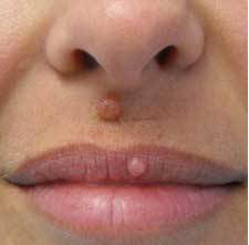 Удаление лазером бородавки на губе до процедуры