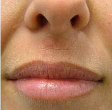Удаление лазером бородавки на губе после процедуры