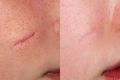 До и после удаления шрама над губой
